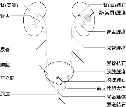 血尿のいろいろな原因