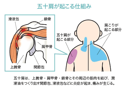 五十肩が起こる仕組み