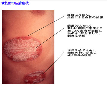 乾癬の皮膚症状