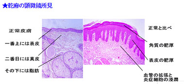 乾癬の顕微鏡所見
