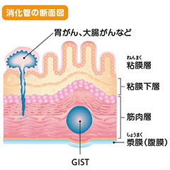 GIST図