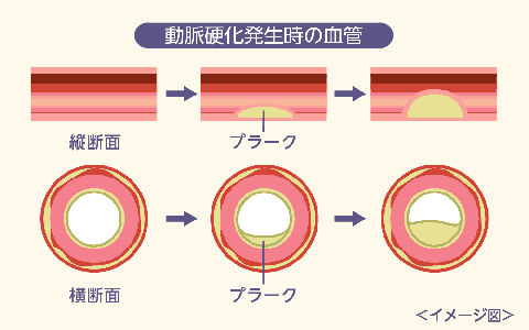 動脈硬化