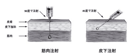 筋肉注射と皮下注射