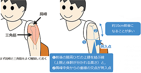 筋肉注射　イラスト 