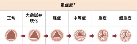 大動脈弁狭窄症重症度